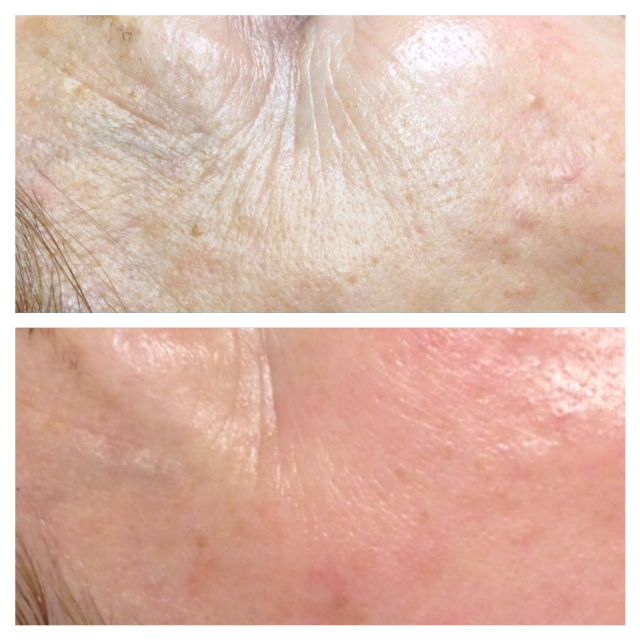Rejuvapen Before and After